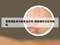 银屑病能用乌侧骨治疗吗 银屑病可以吃乌梅吗