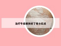 治疗牛皮癣快好了有小红点