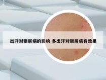 出汗对银屑病的影响 多出汗对银屑病有效果