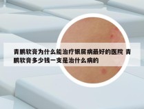 青鹏软膏为什么能治疗银屑病最好的医院 青鹏软膏多少钱一支是治什么病的