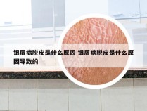银屑病脱皮是什么原因 银屑病脱皮是什么原因导致的
