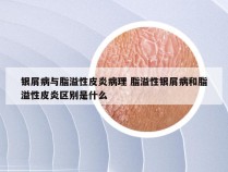 银屑病与脂溢性皮炎病理 脂溢性银屑病和脂溢性皮炎区别是什么