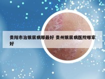 贵阳市治银屑病那最好 贵州银屑病医院哪家好