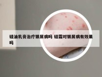 硅油乳膏治疗银屑病吗 硅霜对银屑病有效果吗