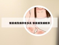 银屑病发病率有多高 银屑病发病概率