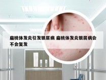 扁桃体发炎引发银屑病 扁桃体发炎银屑病会不会复发