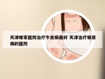 天津哪家医院治疗牛皮癣最好 天津治疗银屑病的医院