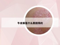 牛皮癣是什么原因得的