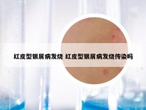 红皮型银屑病发烧 红皮型银屑病发烧传染吗