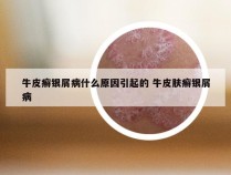 牛皮癣银屑病什么原因引起的 牛皮肤癣银屑病