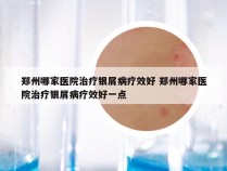 郑州哪家医院治疗银屑病疗效好 郑州哪家医院治疗银屑病疗效好一点