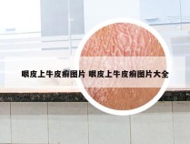 眼皮上牛皮癣图片 眼皮上牛皮癣图片大全