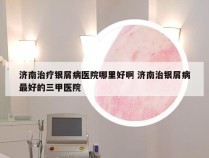 济南治疗银屑病医院哪里好啊 济南治银屑病最好的三甲医院