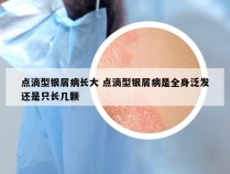 点滴型银屑病长大 点滴型银屑病是全身泛发还是只长几颗
