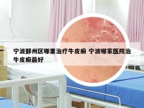 宁波鄞州区哪里治疗牛皮癣 宁波哪家医院治牛皮癣最好