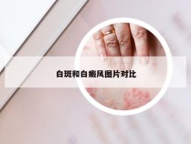 白斑和白癜风图片对比