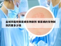 盐城市医院银屑病生物制剂 银屑病的生物制剂药要多少钱