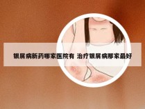 银屑病新药哪家医院有 治疗银屑病那家最好