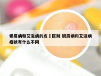 银屑病和艾滋病的皮廯区别 银屑病和艾滋病症状有什么不同
