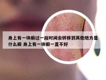 身上有一块癣过一段时间会转移到其他地方是什么癣 身上有一块癣一直不好