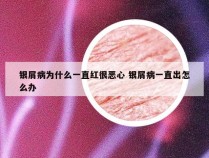 银屑病为什么一直红很恶心 银屑病一直出怎么办