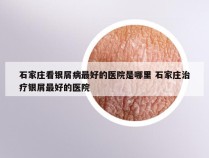 石家庄看银屑病最好的医院是哪里 石家庄治疗银屑最好的医院