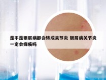 是不是银屑病都会转成关节炎 银屑病关节炎一定会瘫痪吗