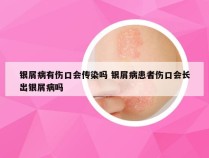银屑病有伤口会传染吗 银屑病患者伤口会长出银屑病吗
