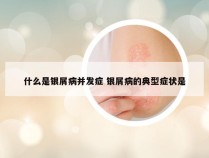 什么是银屑病并发症 银屑病的典型症状是