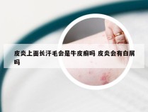皮炎上面长汗毛会是牛皮癣吗 皮炎会有白屑吗