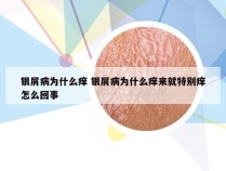 银屑病为什么痒 银屑病为什么痒来就特别痒怎么回事