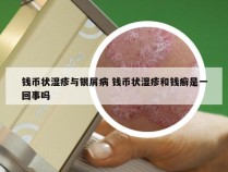 钱币状湿疹与银屑病 钱币状湿疹和钱癣是一回事吗
