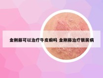 金刚藤可以治疗牛皮癣吗 金刚藤治疗银屑病