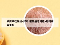银屑病吃阿维a好吗 银屑病吃阿维a好吗有效果吗