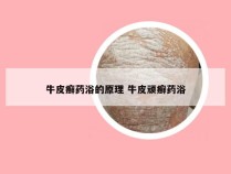牛皮癣药浴的原理 牛皮顽癣药浴
