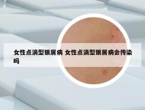 女性点滴型银屑病 女性点滴型银屑病会传染吗