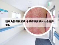 孩子为何得银屑病 小孩得银屑病长大会更严重吗
