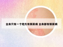 全身只有一个地方有银屑病 全身都有银屑病