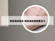 银屑病消褪去 银屑病消褪期要多久