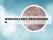 银屑病红斑压之褪色吗 银屑病红斑按压褪色吗