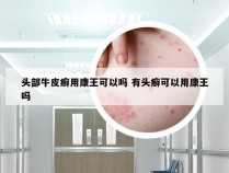 头部牛皮癣用康王可以吗 有头癣可以用康王吗
