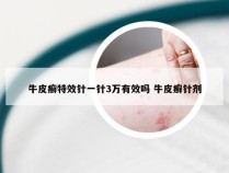 牛皮癣特效针一针3万有效吗 牛皮癣针剂