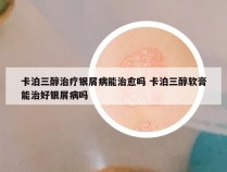 卡泊三醇治疗银屑病能治愈吗 卡泊三醇软膏能治好银屑病吗