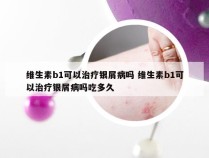 维生素b1可以治疗银屑病吗 维生素b1可以治疗银屑病吗吃多久