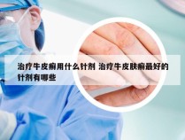 治疗牛皮癣用什么针剂 治疗牛皮肤癣最好的针剂有哪些