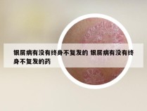 银屑病有没有终身不复发的 银屑病有没有终身不复发的药