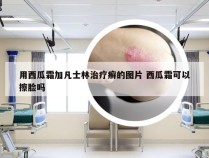 用西瓜霜加凡士林治疗癣的图片 西瓜霜可以擦脸吗