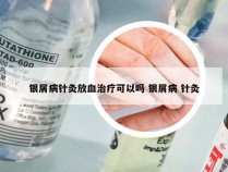 银屑病针灸放血治疗可以吗 银屑病 针灸