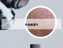 牛皮癣湿气