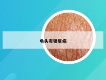 龟头有银屑病